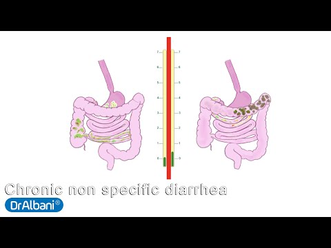 Dr. Roberto Albani- Chronic non specific diarrhea in children (1-5 years old) -