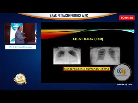 Transfusion Related Acute Lung Injury Prof Ahmed Elsawah