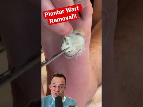 DOCTOR REACTS: SATISFYING WART REMOVAL!😱 #shorts
