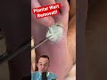 DOCTOR REACTS: SATISFYING WART REMOVAL!😱 #shorts