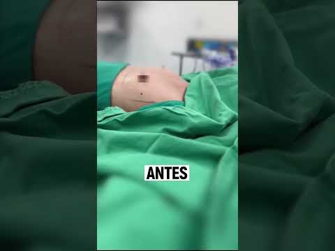 Breast Augmentation in Lima, Peru with Dr Daniel Saco-Vertiz - SurgeryinPeru