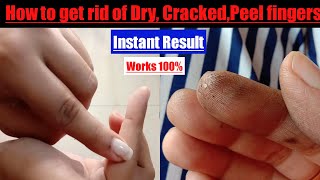 How to get rid of Dry,Rough,Crack,Peeled fingers|Overnight Proper Healing method Winter Care