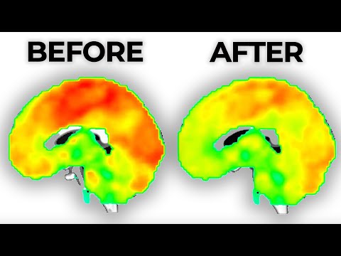 Long-term Effects of Antidepressants on the Brain