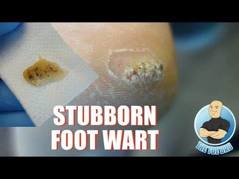 Wart in foot