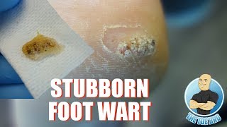 HOW TO TREAT DIFFICULT PLANTAR WARTS REMOVAL - FOOT HEALTH MONTH 2018 #9