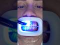 Transformation of Yellow Teeth! #teethwhitening