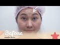 โบท็อก ลดริ้วรอย
