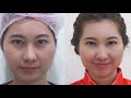 โบท็อก ลดริ้วรอย