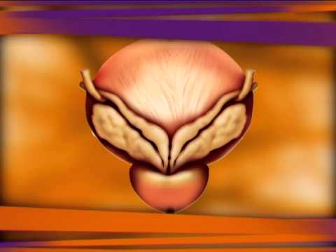 Rote Drachen von Prostatitis Ob es notwendig ist, Prostatitis zu behandeln