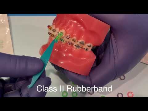 Braces: How to put on Class II Rubber Bands