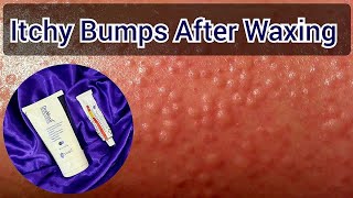 Rashes After Waxing | How To Get Rid Of Itching & Small Bumps After Wax