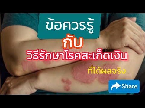 โรคสะเก็ดเงินและโรคเรื้อนกวางกัน Retinoids ในโรคสะเก็ดเงิน
