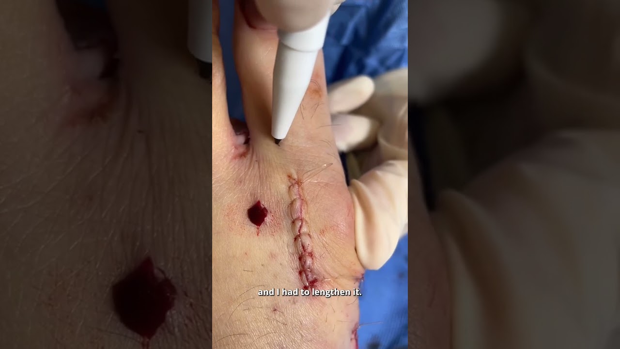 Big Bunionette deformity gets repaired