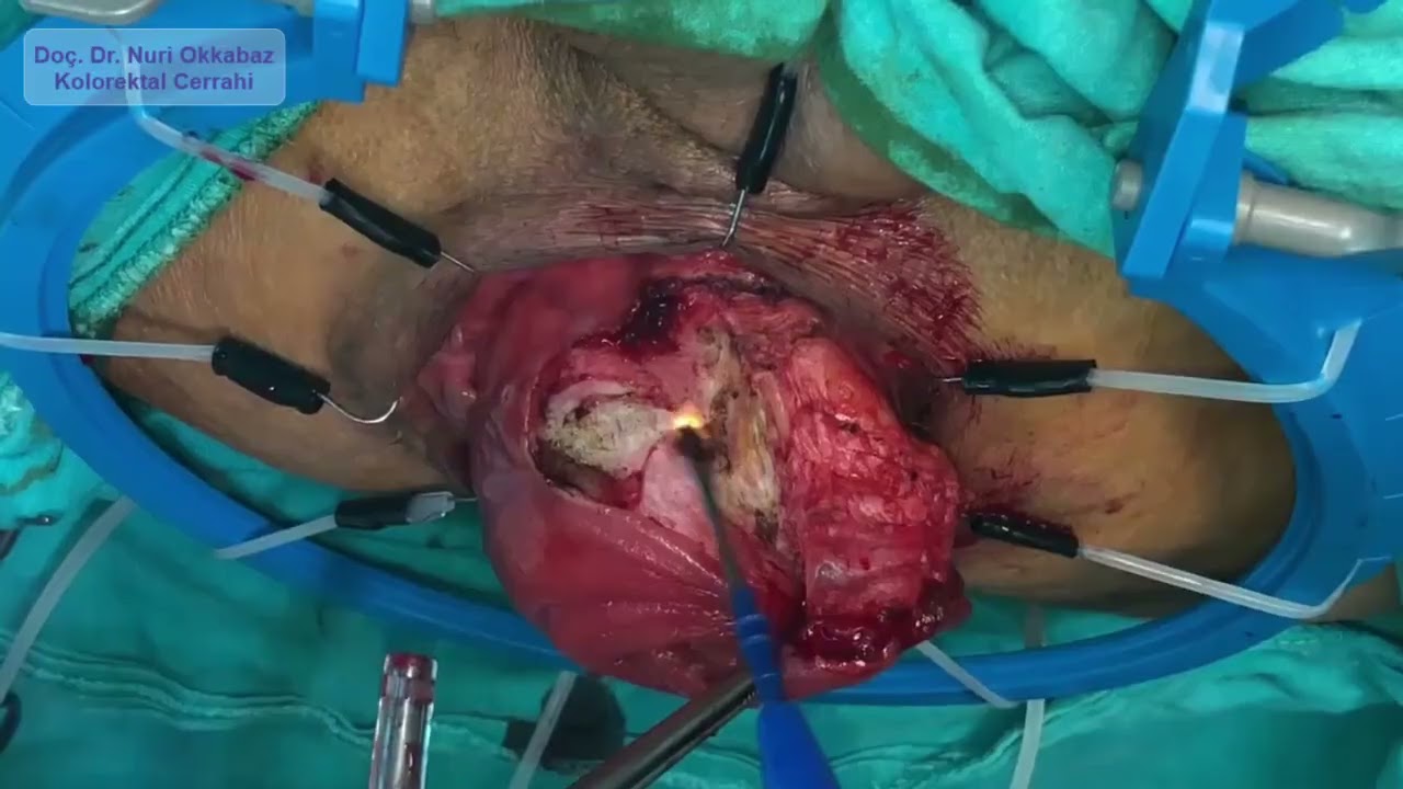 Altemeier Procedure for Rectal Prolapse