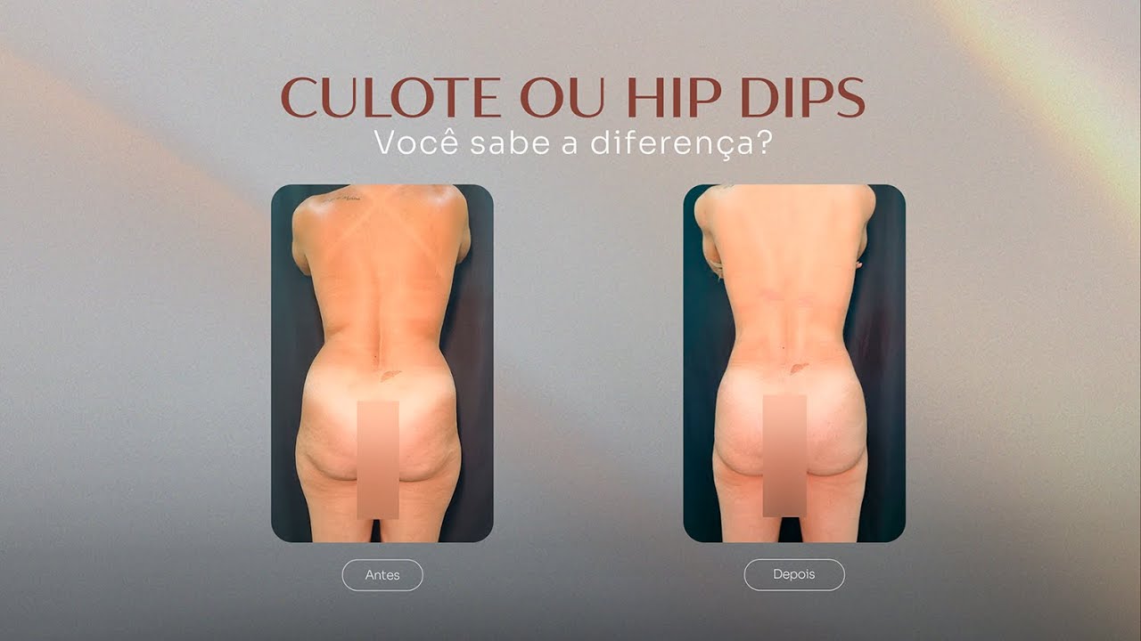 Como perder culote: 4 soluções para eliminar a tão indesejada “gordurinha”