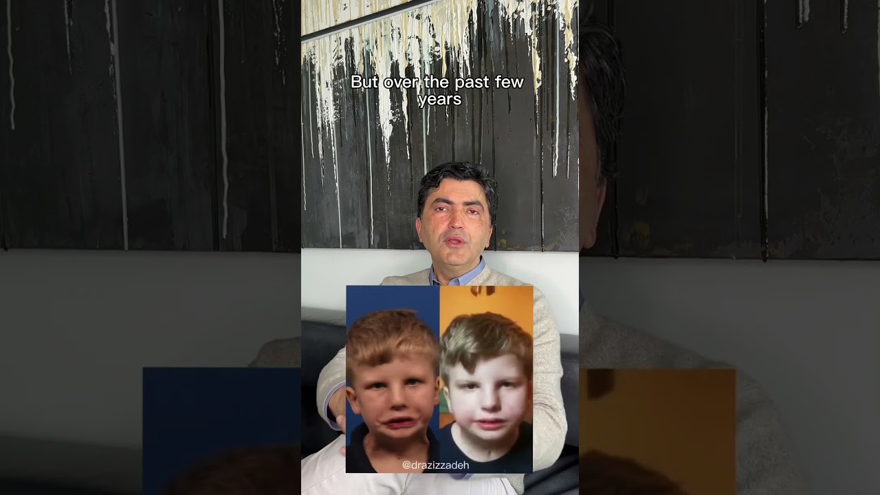 Can you get a natural smile if you have Moebius syndrome? #facialparalysis #facialreanimation