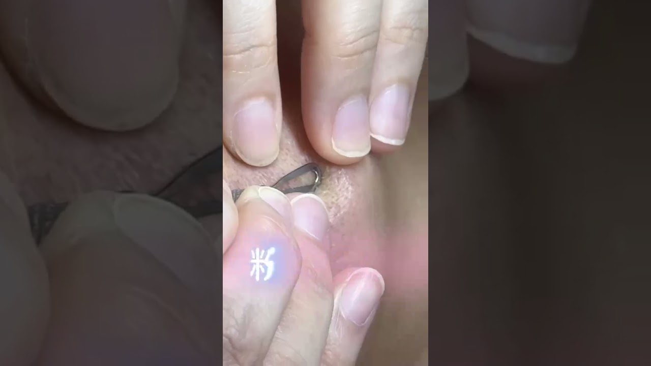 泌容術逆轉肌膚！粉刺痘痘肌的終極救星！