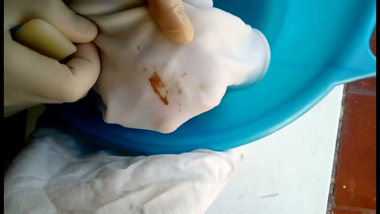 Come togliere macchie di sangue dai tessuti