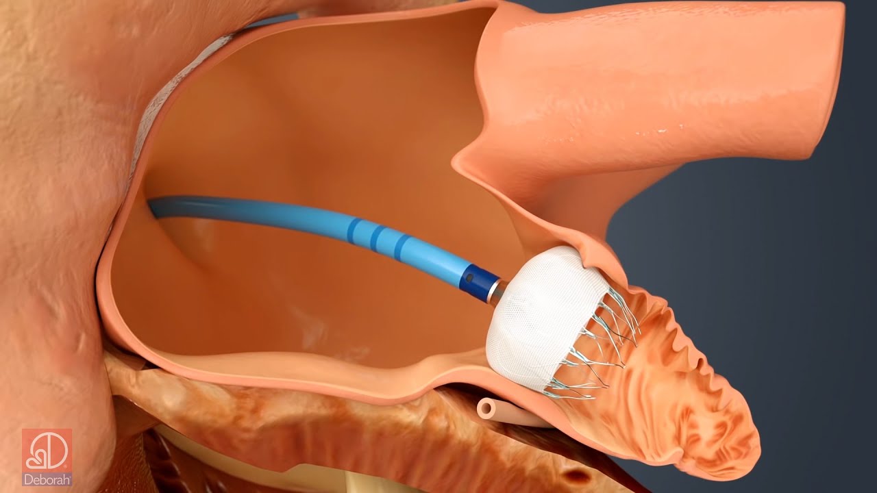 The Watchman Treatment for Atrial Fibrillation (A-Fib)