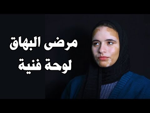 لوحة فنية مش مرض معدى..حكايات مرضى البهاق ورسالتهم لـ رامى جمال