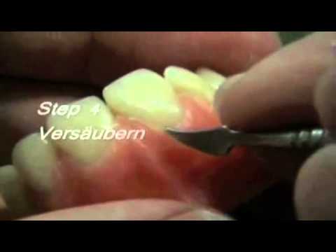 Ausmodellation Zahnersatz