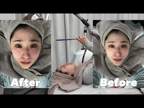 【ムニスキンクリニック】限界スピリチュアルの36歳が占いを信じて美容を頑張り始めた。【本気の無加工Before After】