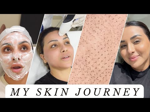 MY SKIN JOURNEY THAT RESULTED IN FLAWLESS MAKEUP APPLICATION | NINA UBHI