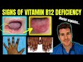 Doctor Explains Clinical Signs Of Vitamin B12 Cobalamin Deficiency Glossitis Mouth Ulcers Etc