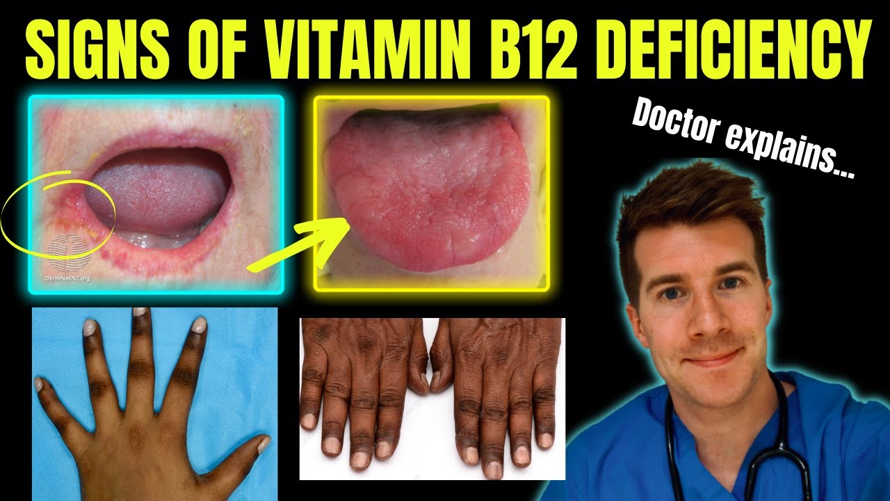 What known vitamin deficiency can cause burning mouth syndrome? EN