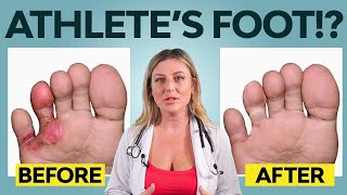 5 Ways to get Rid of Athletes Foot | Treatment