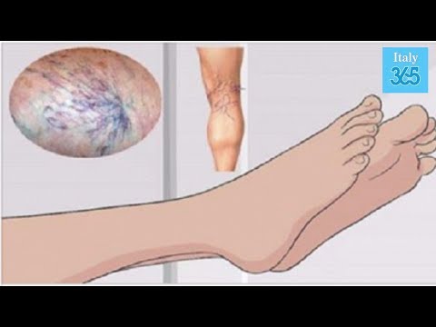 Urinoterapiya da neurodermatitis Eczema sullo sfondo di unallergia