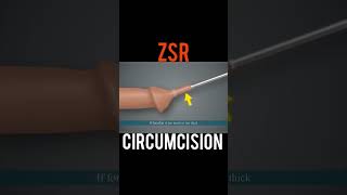 Download lagu ZSR Circumcision  #viral mp3