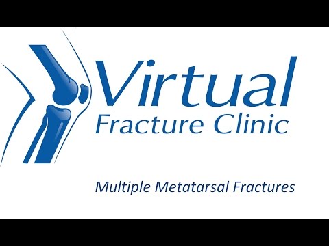 Multiple Metatarsal Fractures