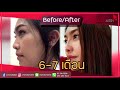 ร้อยไหม