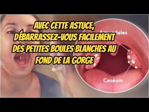 Avec cette Astuce, Débarrassez-vous facilement des petites boules blanches au fond de la gorge