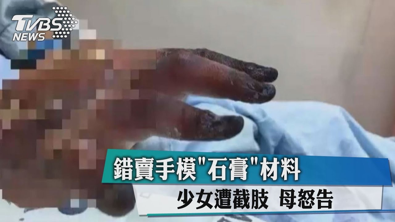 錯賣手模「石膏」材料　少女遭截肢母怒告