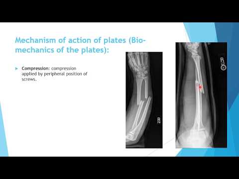 Orthopedic Trauma ; general principles: 1