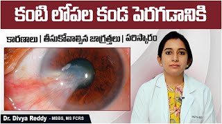 కంటిలో కండకు | Pterygium Causes and Treatment | Eye Care Tips In Telugu | Best Vision Eye Hospital