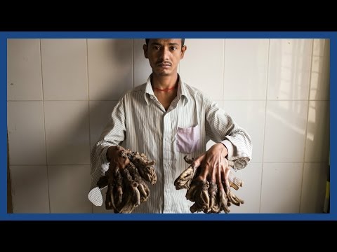 'Tree man’ Abul Bajandar set for life-changing surgery in Bangladesh Video