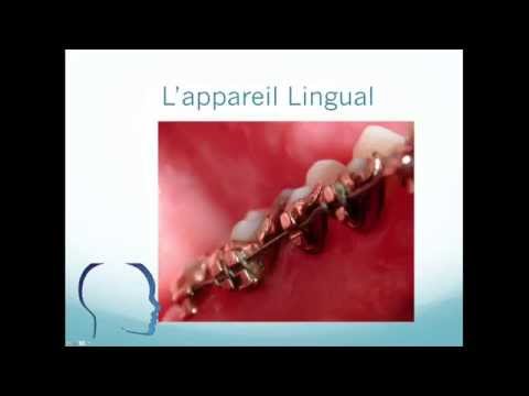 download lagu mp3 mp4 Orthodontie Linguale Paris, download lagu Orthodontie Linguale Paris gratis, unduh video klip Orthodontie Linguale Paris