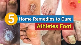 5 Home Remedies to Cure Your Athlete