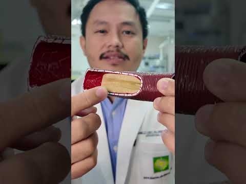 What is Atherosclerosis? | #BeatAteRose