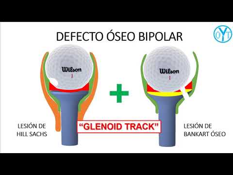 glenoid track de hombro o defecto óseo bipolar