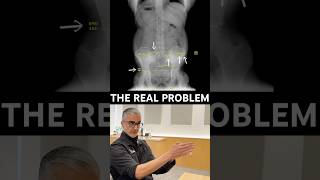 The Disc Wasn’t The Main Problem For His SEVERE Back Pain | Dr. Rahim