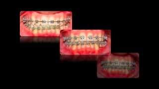Maxillary midline deviation with lack of space for the canine tooth.