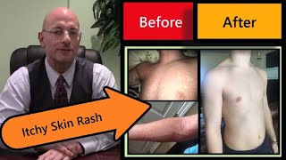 How To Get Rid of Itchy Skin Rash
