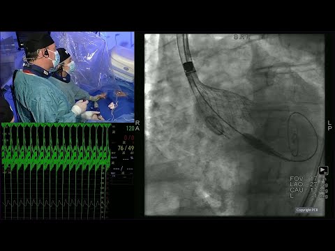 Valve performance and durability - Main considerations in selecting the right TAVI valve