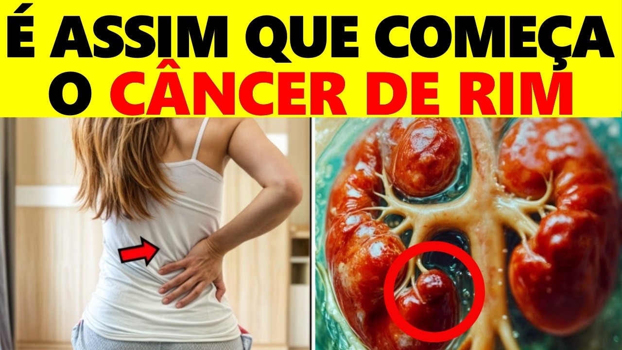 95% das pessoas Ignoram Esses 7 Sinais de Câncer de Rim -  Sinais e Sintomas do Câncer de Rim
