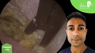 1,118 - Forceps Removal of Extremely Itchy Ear Wax & Dead Skin