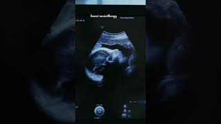 Bébé dans l'utérus et battements de son cœur 🎧 Baby in womb and heartbeat (1-2)